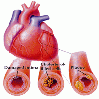 Đông trùng hạ thảo làm giảm cholesterol trong máu Đông trùng hạ thảo làm giảm cholesterol trong máu