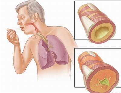 ĐIỀU TRỊ VIÊM PHẾ QUẢN BẰNG ĐÔNG TRÙNG HẠ THẢO